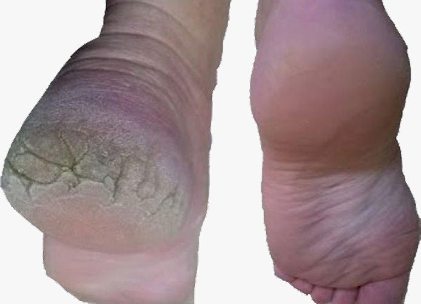 Miniatura Creme Tratamento Rachadura Nos Pés 200G Eliminação Completa