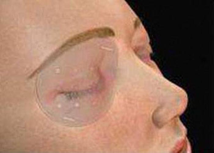 Miniatura Oclusor Acrílico Estéril - Protetor Ocular