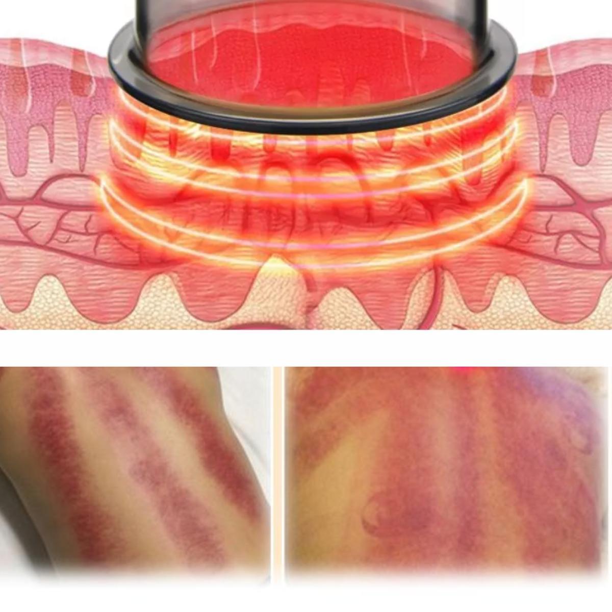 Ventosaterapia Ventosa Elétrica Vácuo Massageadora Estética