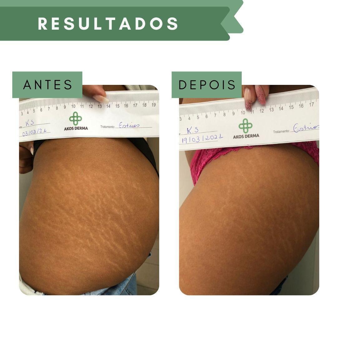 Miniatura Ade150 - Akos Derma Creme Hidratante Para Estrias 150Ml Creme - Hidratante - Estrias - Estrias vermelhas, brancas e . - Akos Derma - Corpo