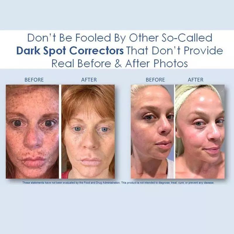 Miniatura Creme Manchas Melasma Ultra Potente Ácidos 2% Hidroquinona Produto Importado Nacional - Emulsão - Anti-manchas - Ultra-potente 2% hidroquinona - 30 - Mista - 1