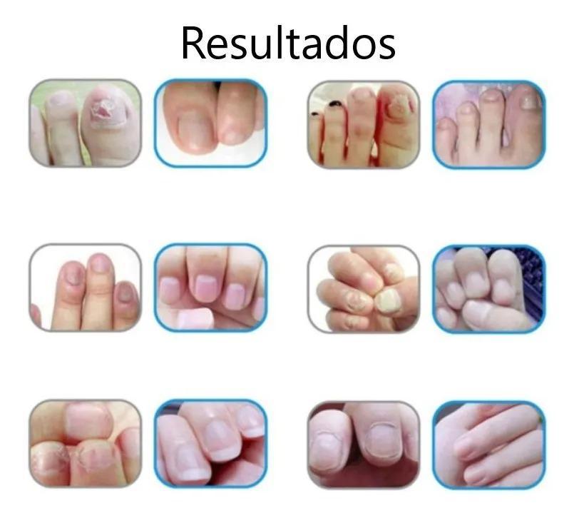 Miniatura Caneta Esmalte Anti Fungo Micose Fortalece Unhas 3 Peças