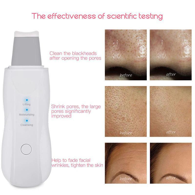 Removedor De Cravos Espátula Peeling Ultrassónico Portátil