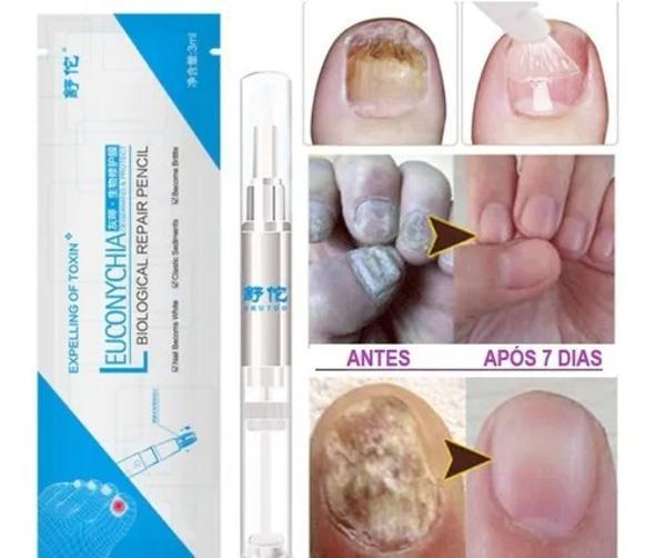 Miniatura Caneta Esmalte Anti Fungo Micose Fortalece Unhas 3 Peças