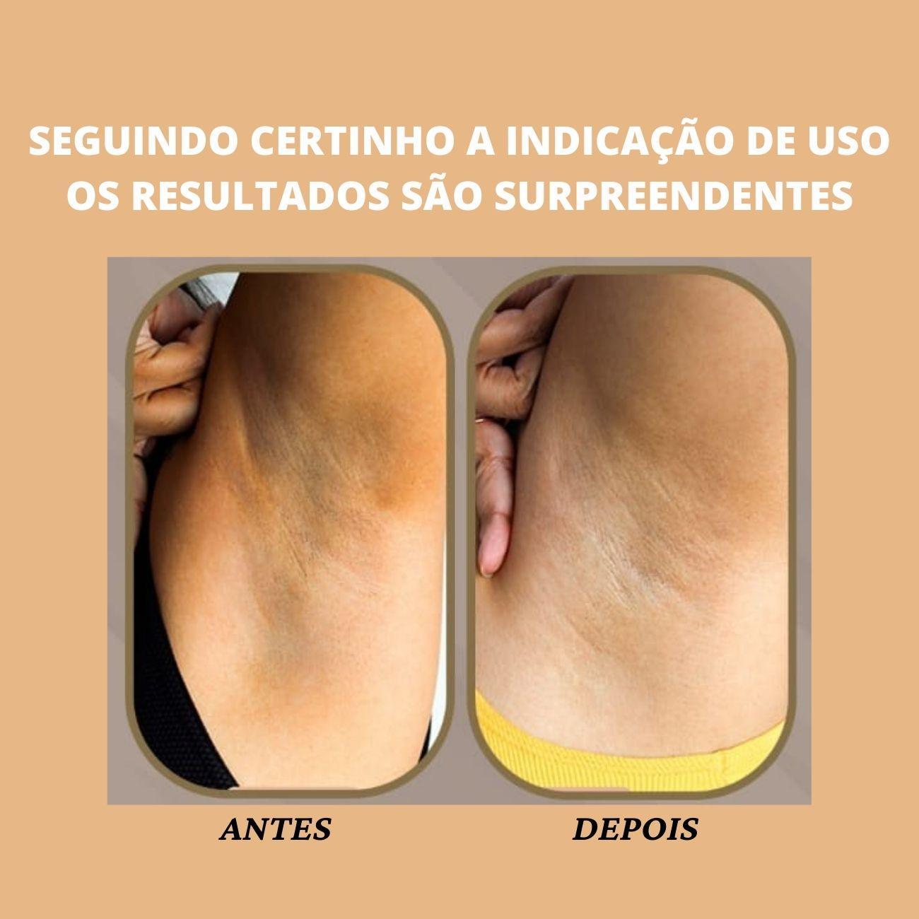 Miniatura Clareamento De Pele Íntima Virilha Axila E Entre Coxa Lisa