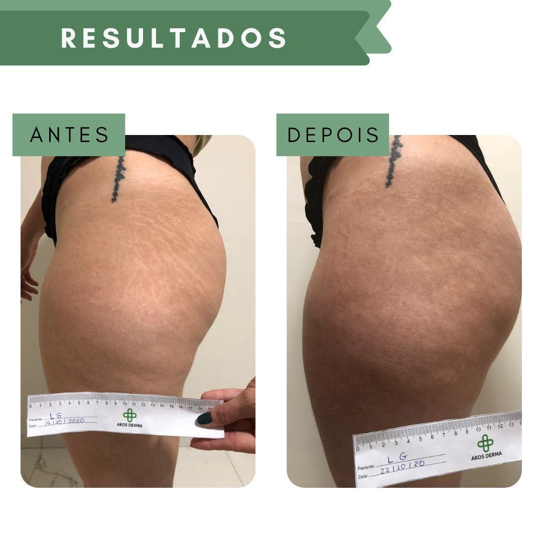Miniatura Ade150 - Akos Derma Creme Hidratante Para Estrias 150Ml Creme - Hidratante - Estrias - Estrias vermelhas, brancas e . - Akos Derma - Corpo