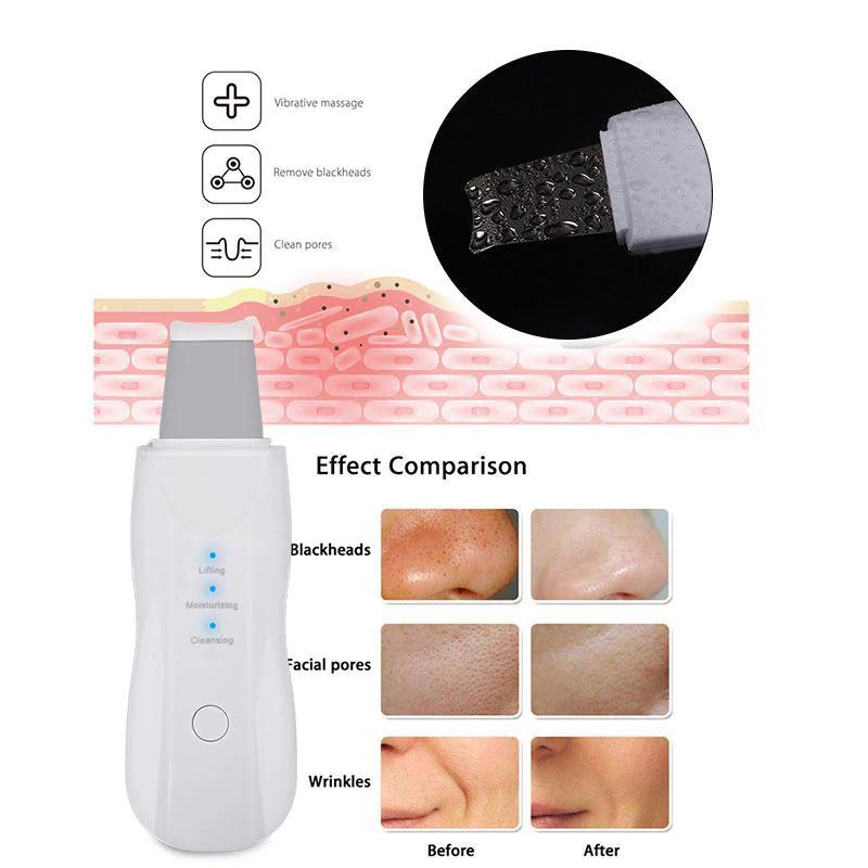 Miniatura Removedor De Cravos Espátula Peeling Ultrassónico Portátil